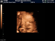 Vivian Sonograms